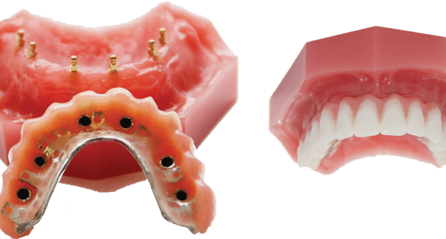 como maximizar la cobertura del seguro para los implantes dentales