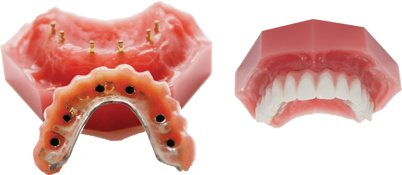 como maximizar la cobertura del seguro para los implantes dentales