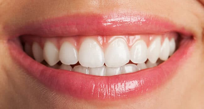 el seguro dental cubre el tratamiento de blanqueamiento dental