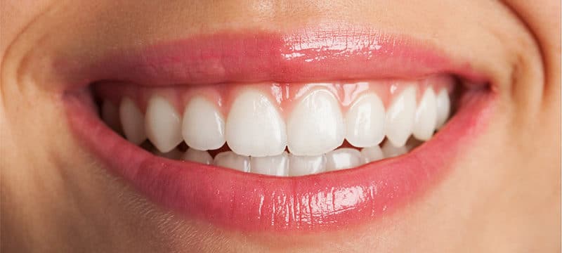 el seguro dental cubre el tratamiento de blanqueamiento dental